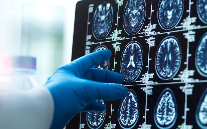 Brain cancer needs a national plan